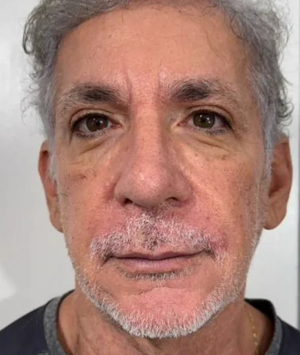 Depois do Microfocado: cliente de frente.