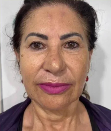 Depois do Microfocado: cliente de frente.