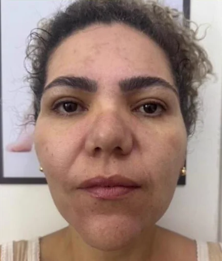 Antes do Microfocado: cliente de frente.